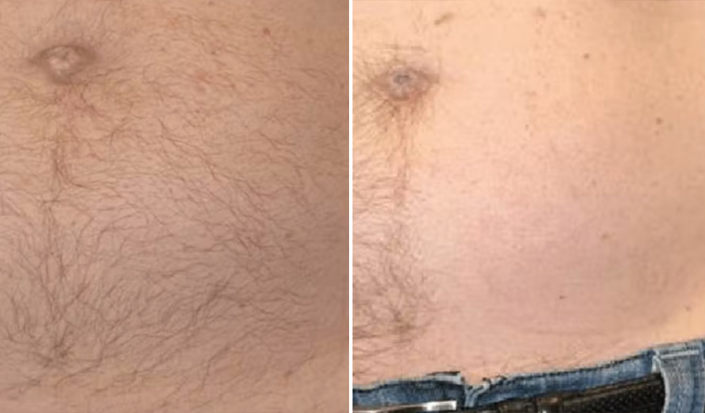 before-after-hair-removal