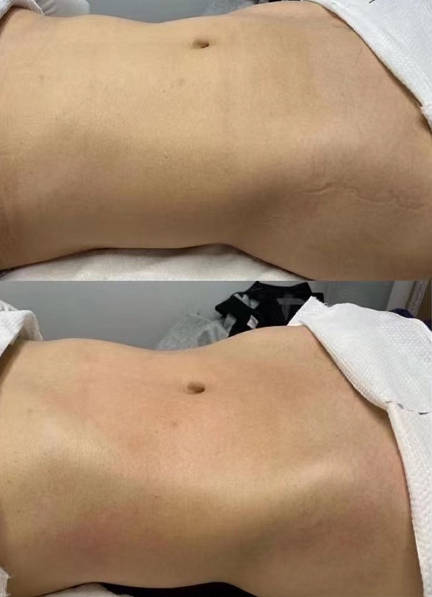 fat reduction auckland